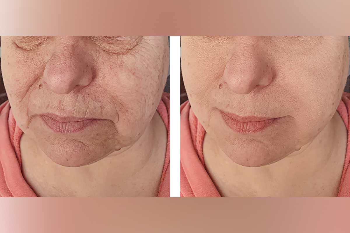 Fractionated CO2 Laser Resurfacing treatment Before and After results