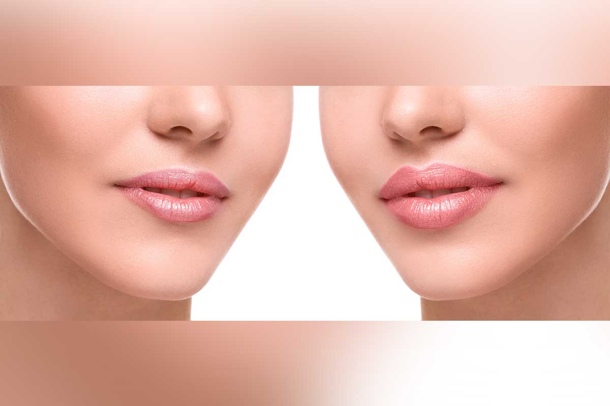 Lips filler treatment before and after in Palm Beach area