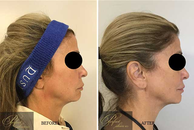 Profound filler treatment before after