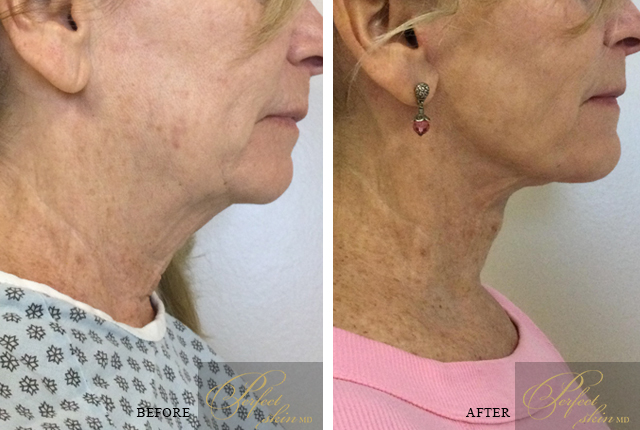 Real patient's neck after surgical neck lift treatment
