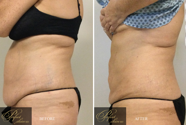 Before & After image of Tumescent Liposuction in Palm Beach area 