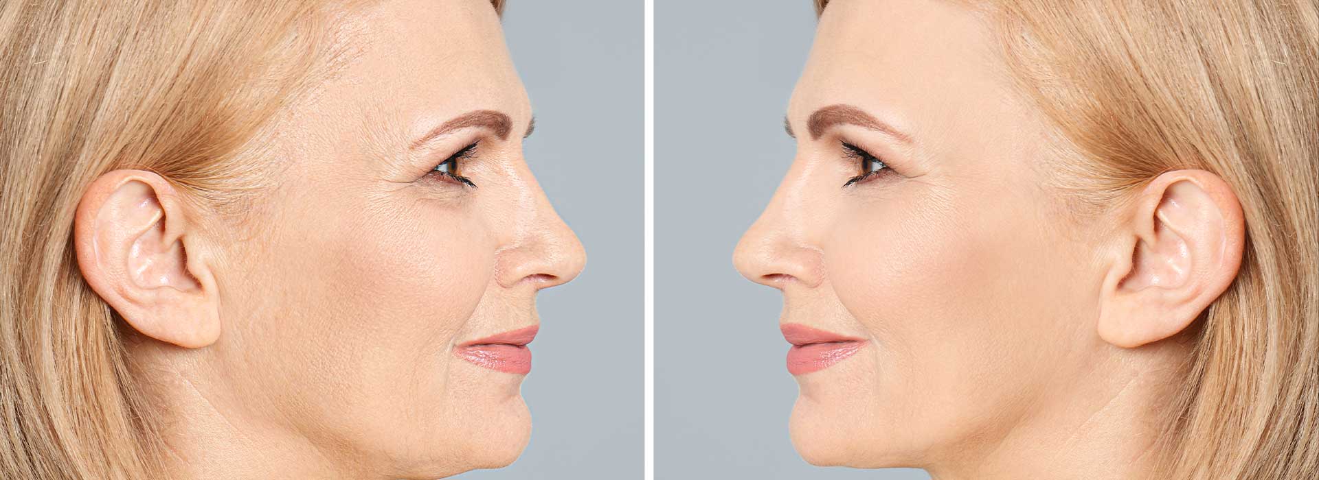 Recontouring with Fillers treatments at Perfect Skin MD