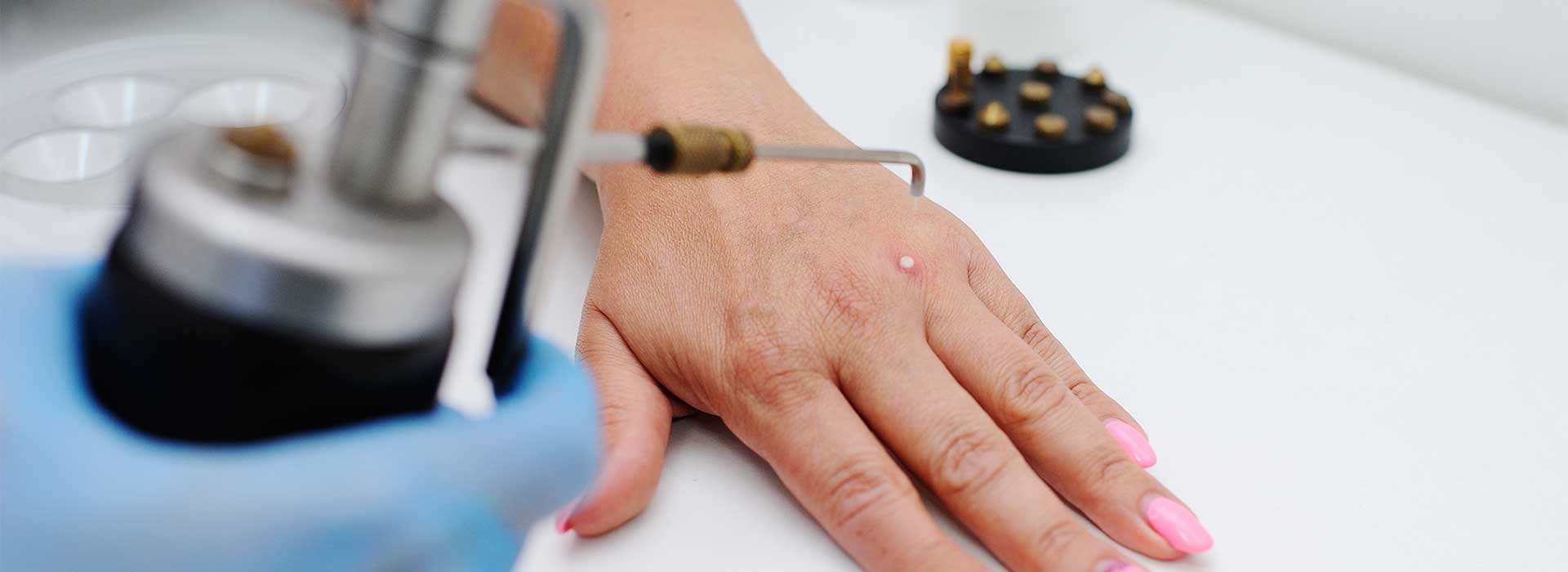 Removal of warts in dermatology clinic at Perfect Skin MD